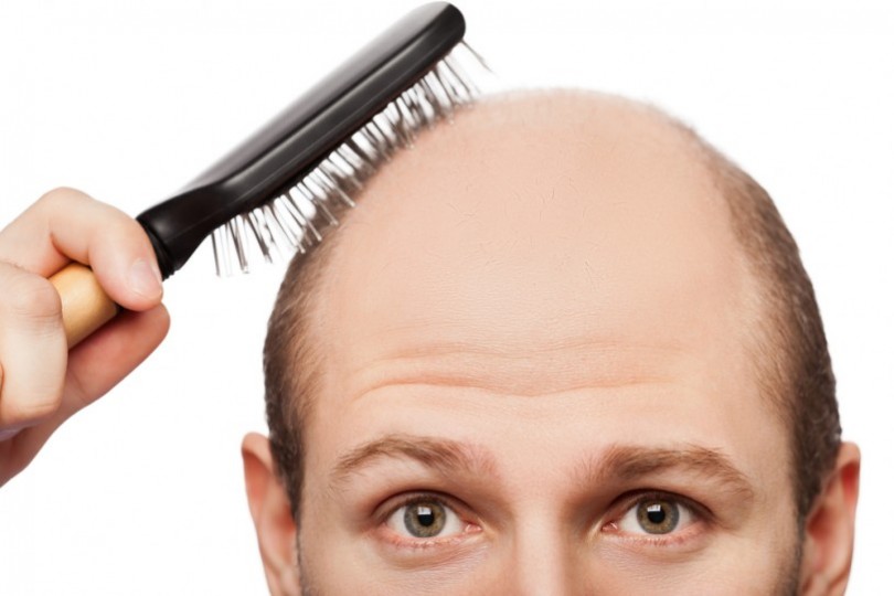 شركة تركية تطور علاجا للصلع كبديل لزراعة الشعر القدس العربي