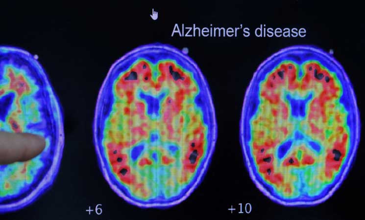 وكالة الأدوية الأوروبية رفضت طرح دواء يبطئ تطور مرض ألزهايمر